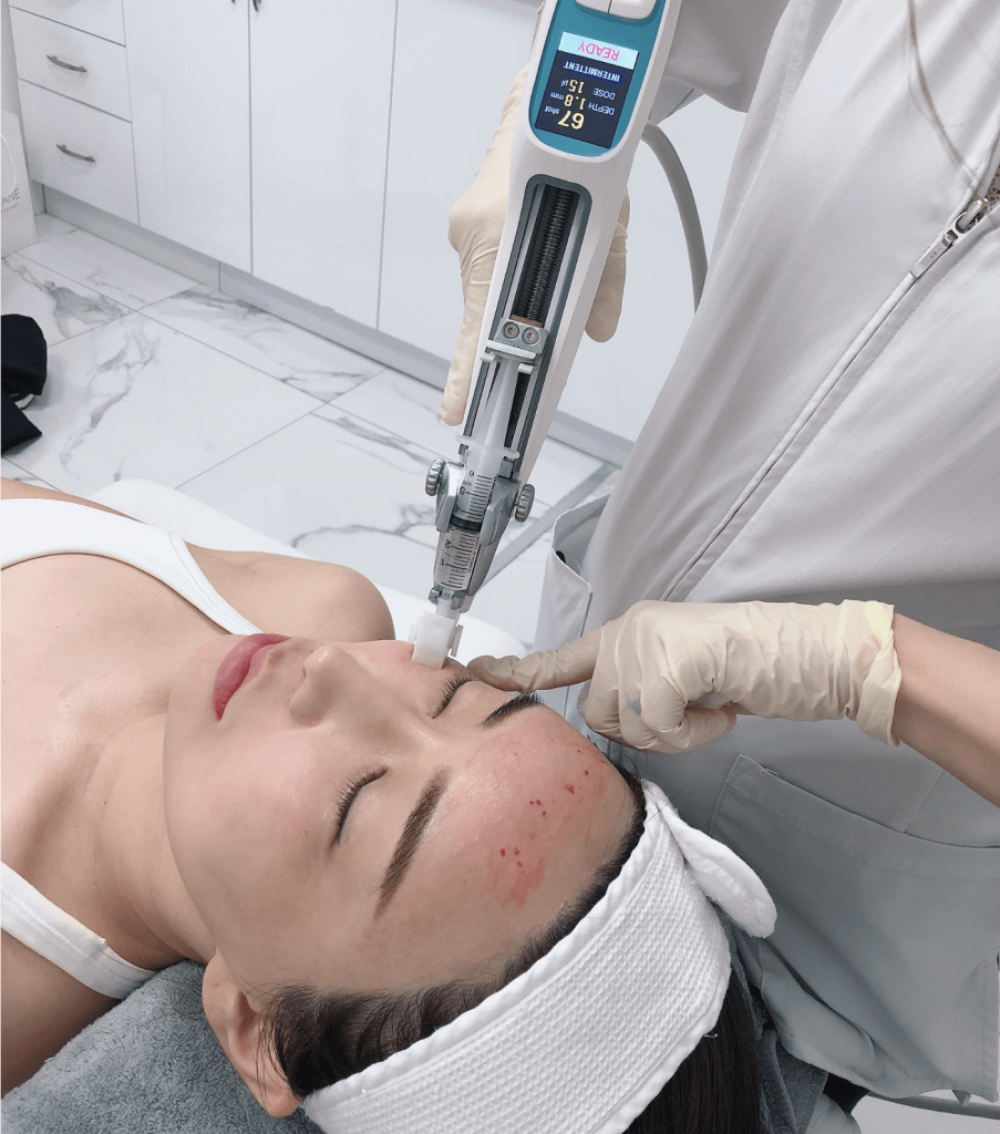 Mesotherapy-水光针-多伦多