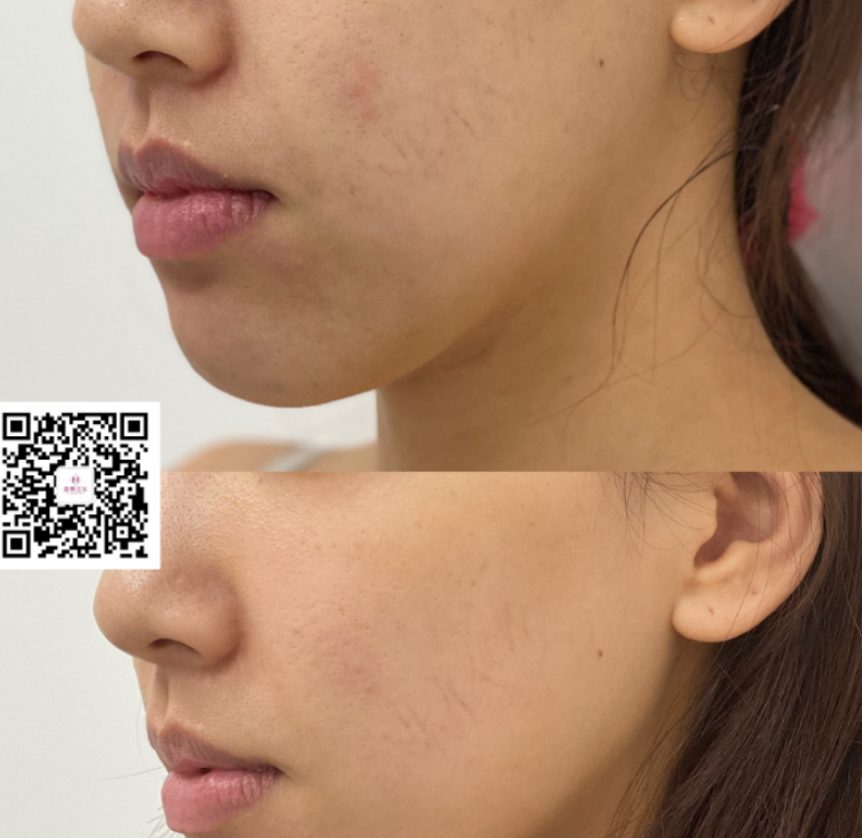 thermage-toronto-4-1