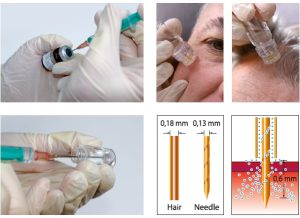 黄金微针的治疗原理 1