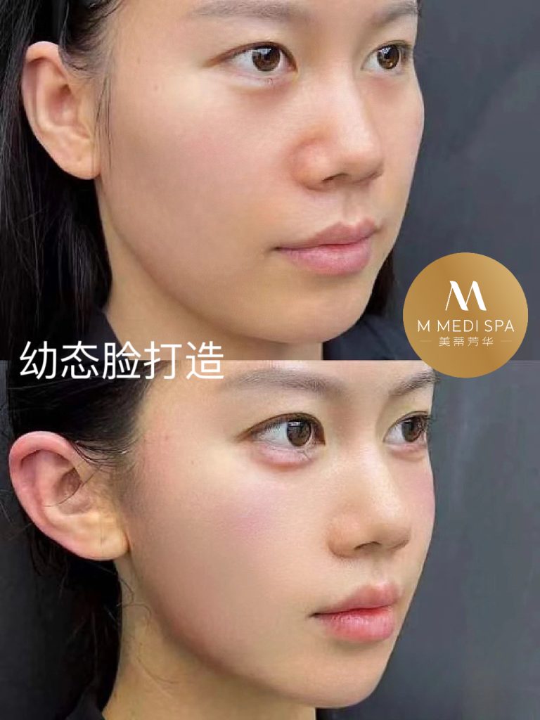 玻尿酸幼态脸打造 1