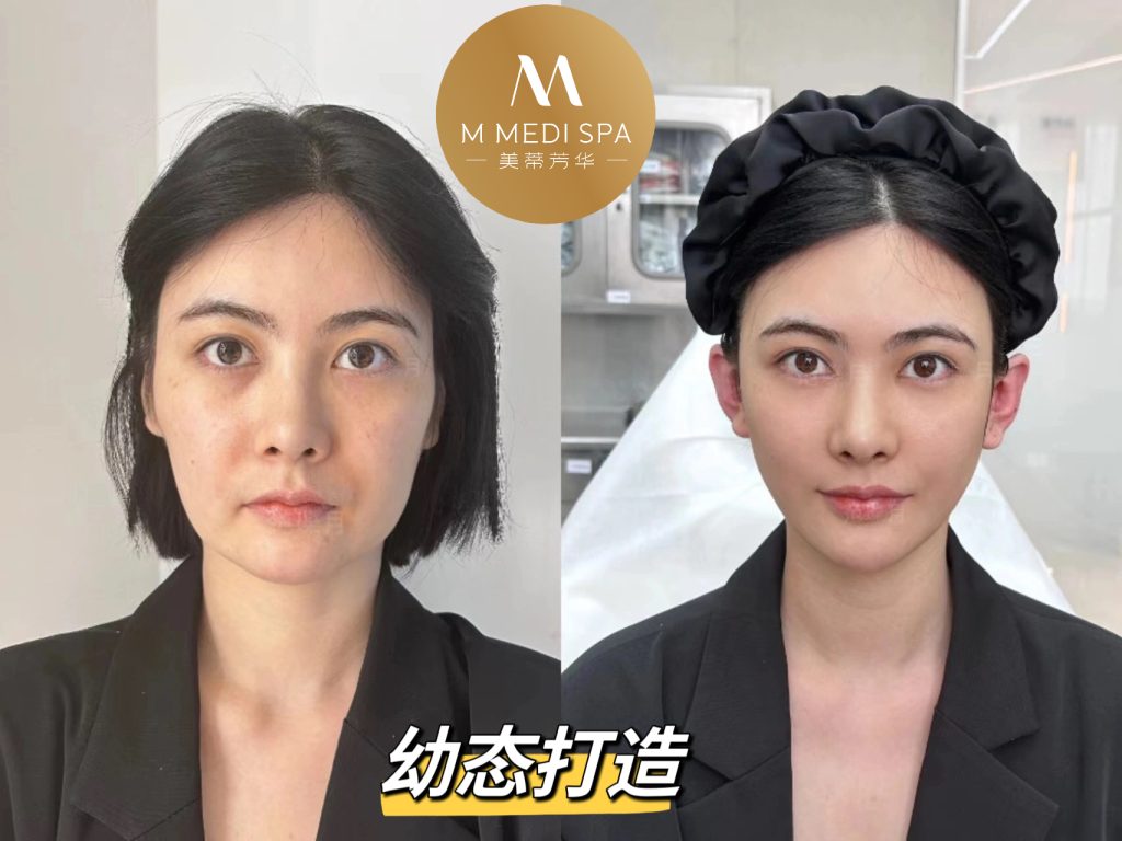 玻尿酸幼态脸打造 2