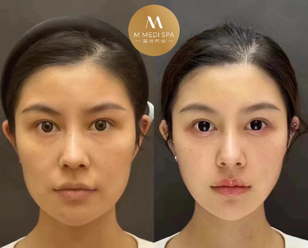 玻尿酸幼态脸打造 3