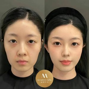 玻尿酸填充 多伦多 2