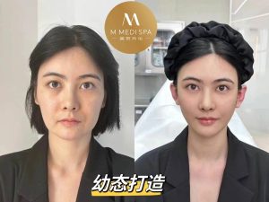 玻尿酸填充 多伦多 3