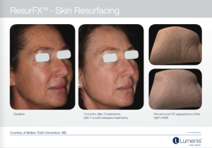 M22光子嫩肤 多伦多