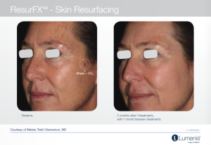 M22光子嫩肤 多伦多