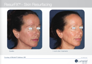 M22光子嫩肤 多伦多