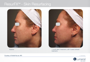 M22光子嫩肤 多伦多