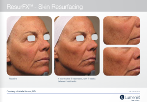 M22光子嫩肤 多伦多