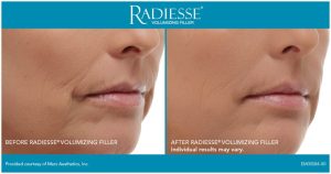 绝经后抗衰 微晶瓷 1