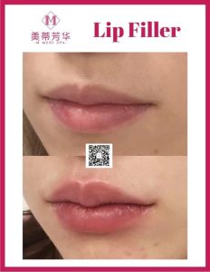 绝经后抗衰 玻尿酸 2