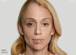 绝经后抗衰 童颜针 1