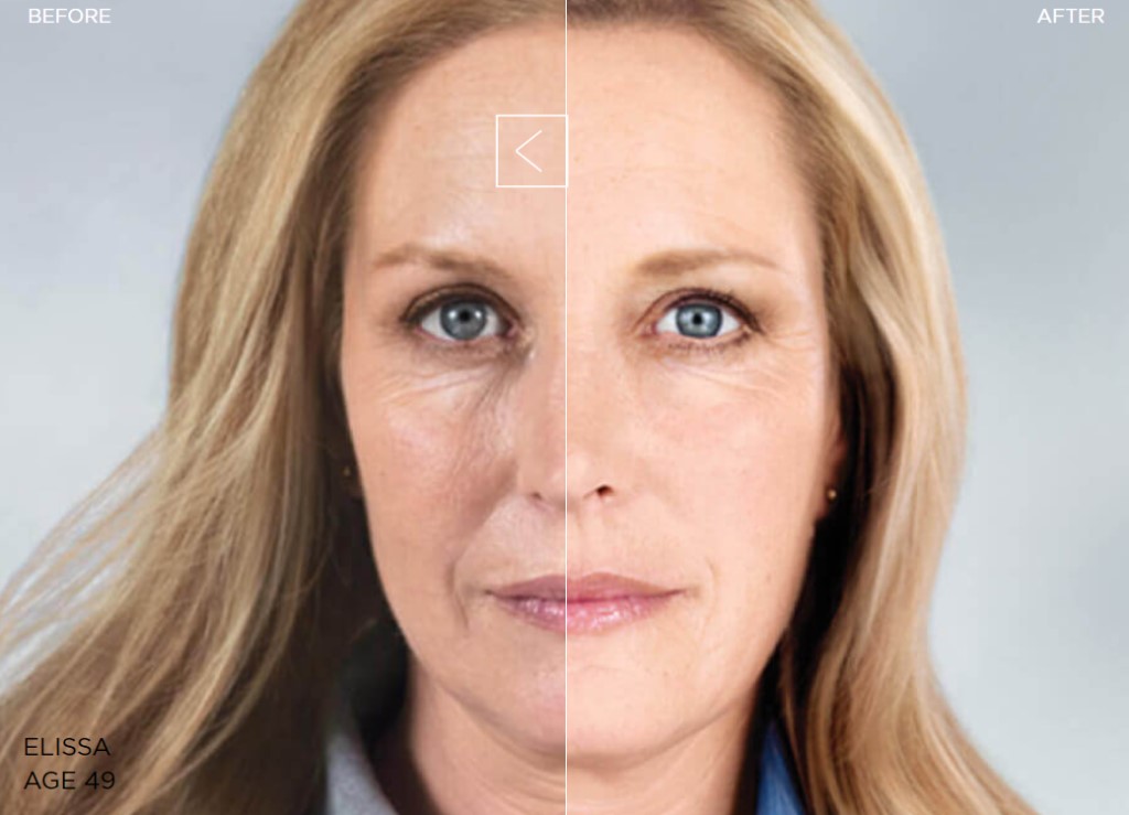 绝经后抗衰 童颜针 2