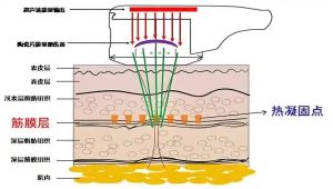 超声刀聚焦过程