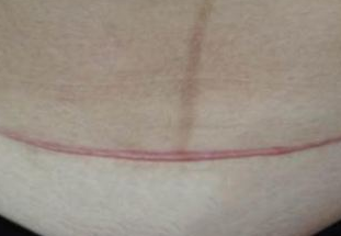 剖腹产疤痕 2025 激光价格地图：多伦多 vs 温哥华差价 5000，美蒂芳华助你选对疗法