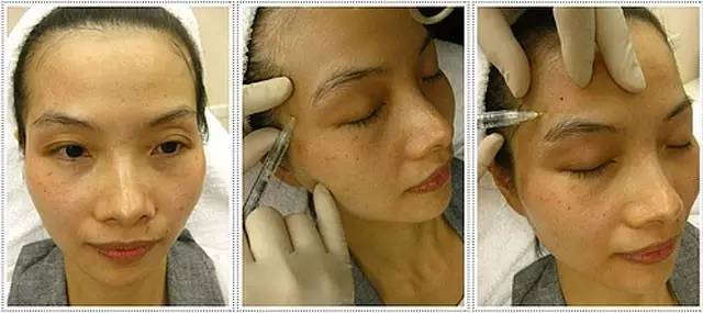 美蒂芳华 M Medi Spa 是多伦多专业医美诊所，提供玻尿酸填充服务。本文从价格、效果、常见问题及周期等方面介绍，助您了解并选择我们的项目，开启焕颜之旅。