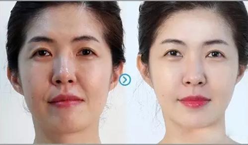 多伦多美蒂芳华 M Medi Spa 超声刀美容全攻略：价格、效果、周期与常见问题大揭秘