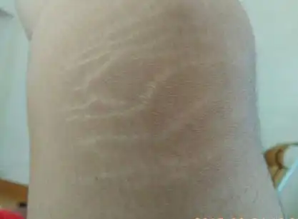 多伦多美蒂芳华 M Medi Spa 带来生长纹修复 2025 新科技 —— 加拿大首创干细胞涂层技术，专业团队定制方案，价格合理、效果显著，全程贴心服务，助你告别生长纹困扰。