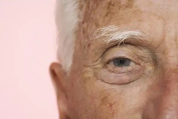 老年斑冷冻治疗真相 | 多伦多美蒂芳华安全解决方案