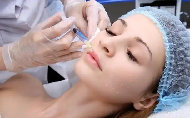 嘴角纹线雕修复