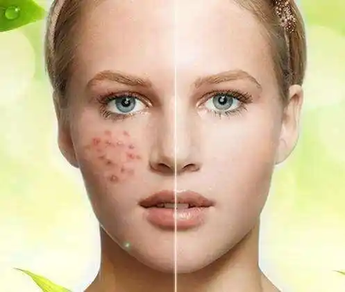 痘坑填充 自体脂肪存活率 美蒂芳华 M Medi Spa