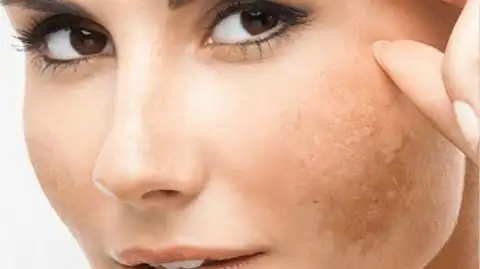 【2025权威指南】晒斑光子嫩肤反黑期3个月？